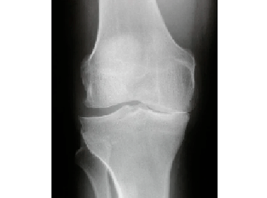 Diagnóstico de artrosis de la articulación de la rodilla
