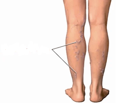 Las consecuencias de la artrosis de la rodilla