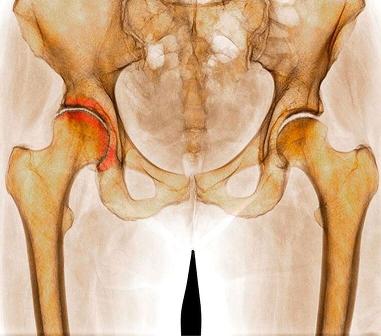 Artrosis de la articulación de la cadera