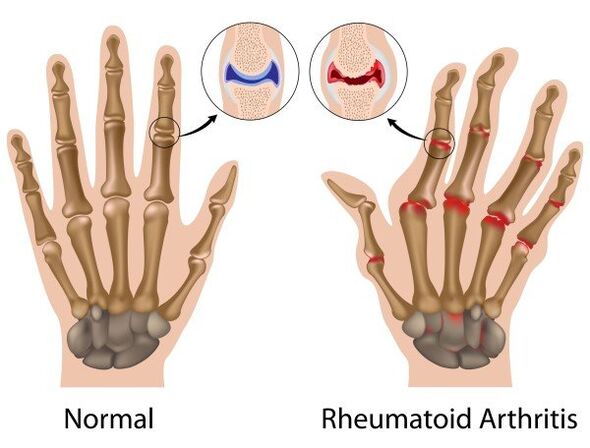 Juntas de dedos sin patología y con artritis reumatoide