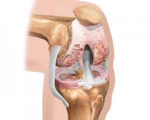 la etapa inicial de la artrosis de rodilla
