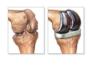 reemplazo de rodilla para la artrosis