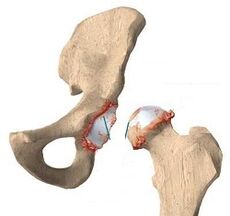 Las razones para el desarrollo de la artrosis de la articulación de la cadera