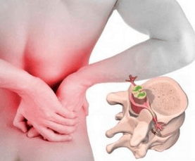 Lumbago al comienzo de la osteocondrosis de la enfermedad