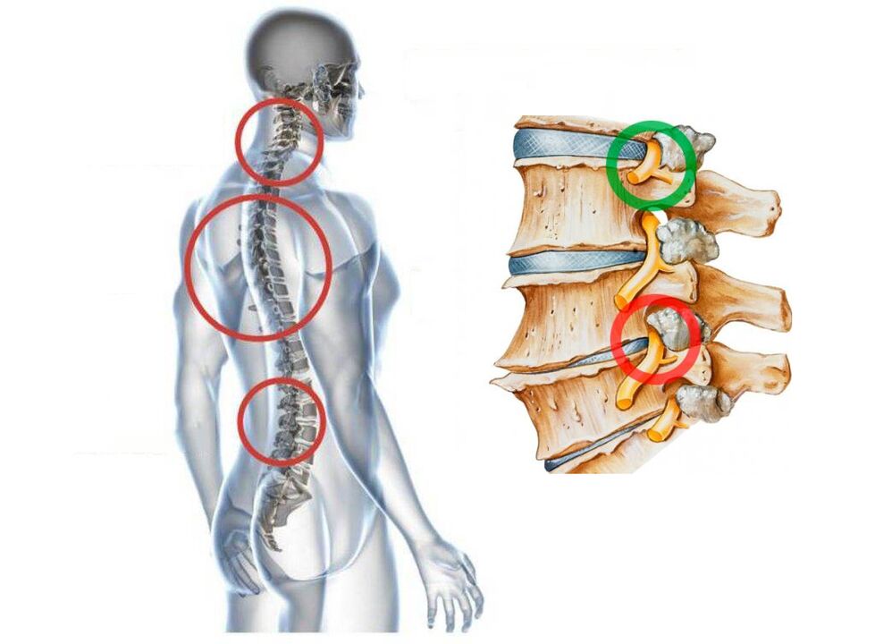 ¿Cómo se ve la osteocondrosis cervical de las vértebras