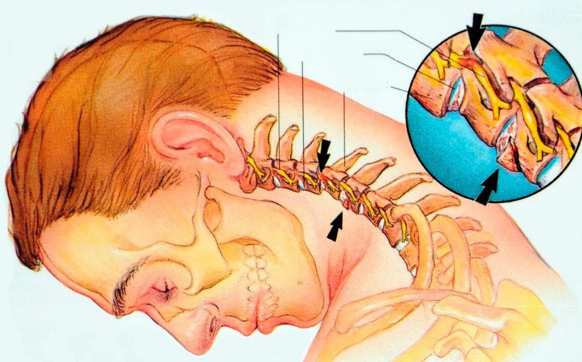 ¿Qué es la osteocondrosis cervical