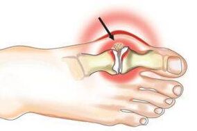 Daño articular debido a artritis y artrosis.