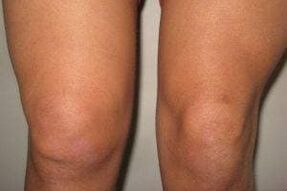 Inflamación en la articulación de la rodilla con artritis y artrosis.