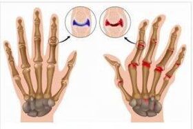 diferencias entre artritis y artrosis de las manos