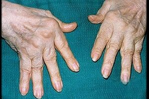síntomas de artritis en los dedos