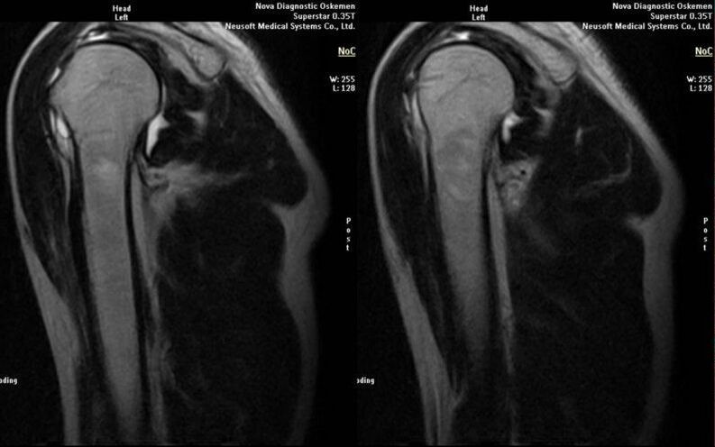 artrosis de la articulación del hombro en radiografía