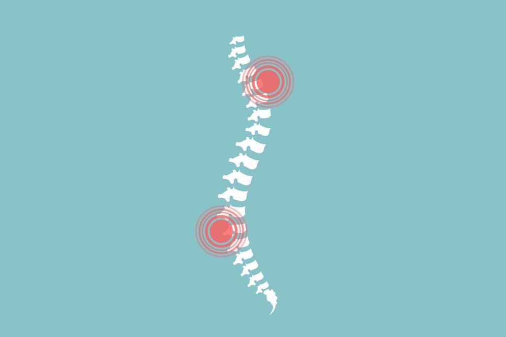columna vertebral humana y dolor de espalda
