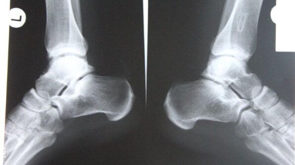 Diagnóstico de artrosis de tobillo mediante radiografía. 