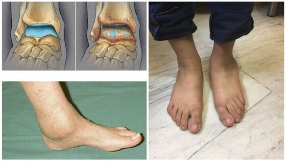 Hinchazón y deformación de la articulación del tobillo debido a artrosis. 